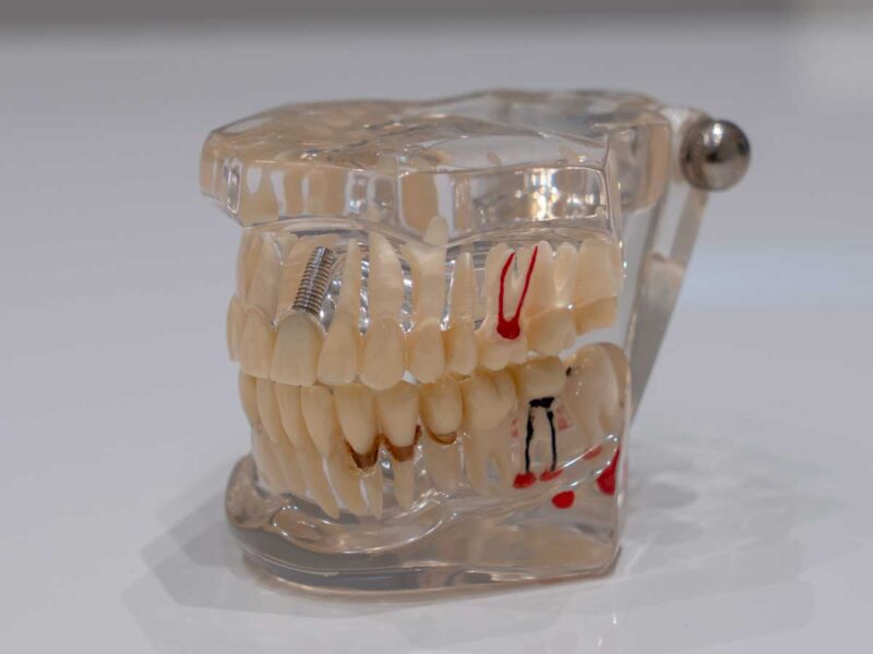 DENTAL CENTAR MIRKOVIĆ - stomatološka ordinacija Novi Sad - slika proteze