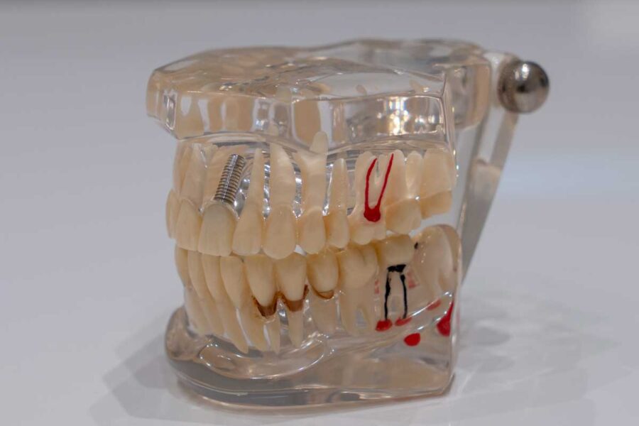 DENTAL CENTAR MIRKOVIĆ - stomatološka ordinacija Novi Sad - slika proteze